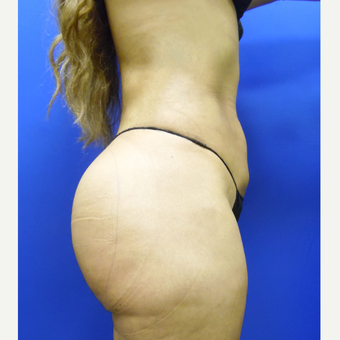 25-34 year old man treated with Butt Implants after 3851719