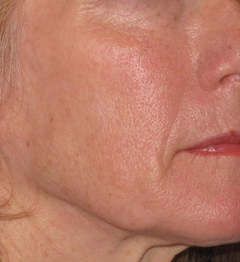 55 year old treated with Voluma in cheeks after 1253788