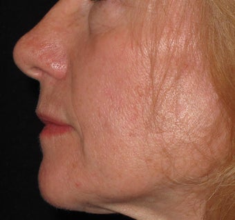 55 year old treated with Voluma in cheeks 1253788