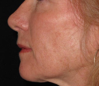 55 year old treated with Voluma in cheeks 1253788