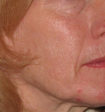 55 year old treated with Voluma in cheeks before 1253788