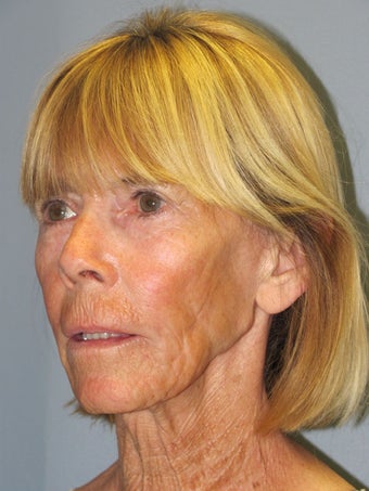 Chemical Peel - Blue Peel 956799