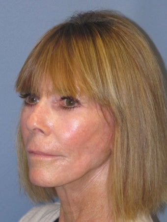 Chemical Peel - Blue Peel 956799
