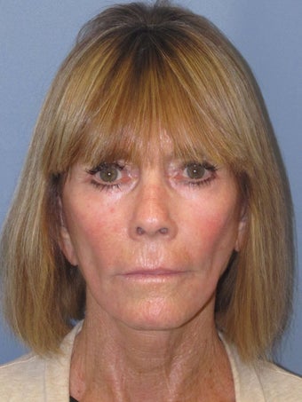 Chemical Peel - Blue Peel after 956799