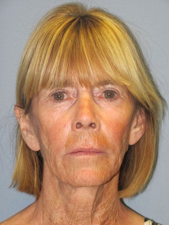 Chemical Peel - Blue Peel before 956799