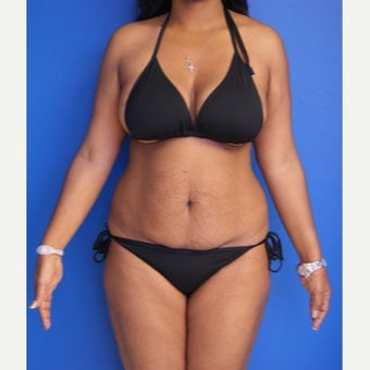 35-44 year old woman treated with Tummy Tuck before 2554190