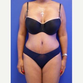 35-44 year old woman treated with Tummy Tuck after 2554190