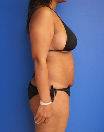 35-44 year old woman treated with Tummy Tuck 2554190