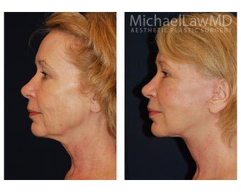 Lower Face Lift before 1299214
