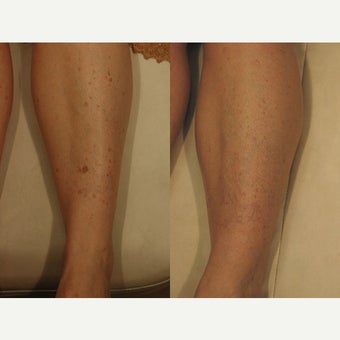 45-54 year old woman treated with Age Spots Treatment before 1660012