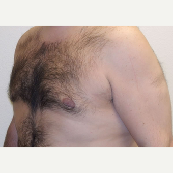 38 year old man treated with Liposuction after 3683785
