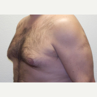 38 year old man treated with Liposuction before 3683785