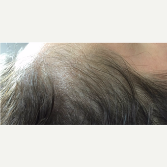 25-34 year old woman treated with PRP for Hair Loss before 3725592