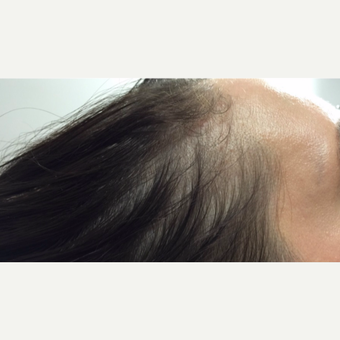 25-34 year old woman treated with PRP for Hair Loss after 3725592