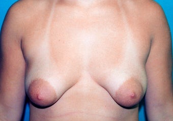 Tuberous Breast Augmentation (Dual Plane ) + Periareolar Mastopexy before 349480