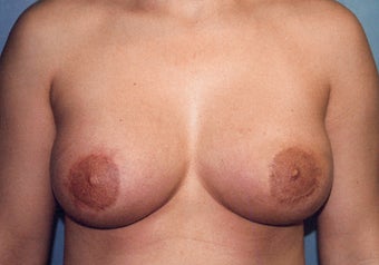 Tuberous Breast Augmentation (Dual Plane ) + Periareolar Mastopexy after 349480