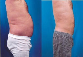 37-year-old man treated with Liposuction. after 347800