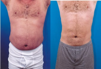 37-year-old man treated with Liposuction. before 347800