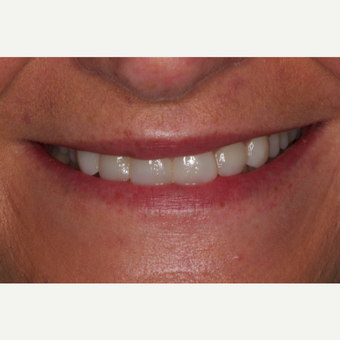 35-44 year old woman treated with Dental Bonding after 2696873