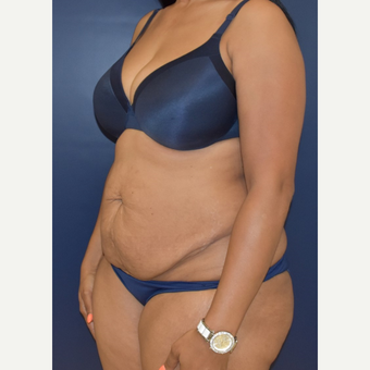 25-34 year old woman treated with Tummy Tuck before 3844748
