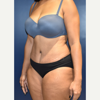 25-34 year old woman treated with Tummy Tuck after 3844748