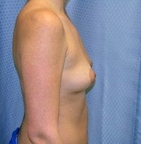 Breast Enlargement 1227629