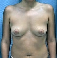 Breast Enlargement before 1227629