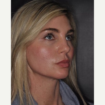 35-44 year old woman treated with Radiesse after 2454494