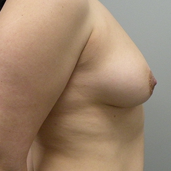 35-44 year old woman treated with Breast Augmentation 2959446