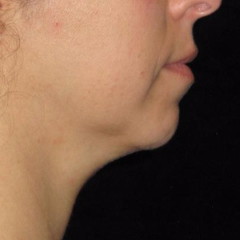 45 year old woman treated with Kybella before 3782590