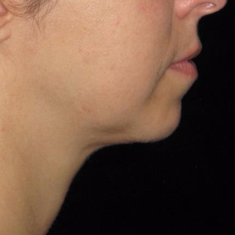 45 year old woman treated with Kybella after 3782590