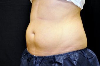27 Year Old Female underwent Coolsculpting to lower abdomen before 1028410