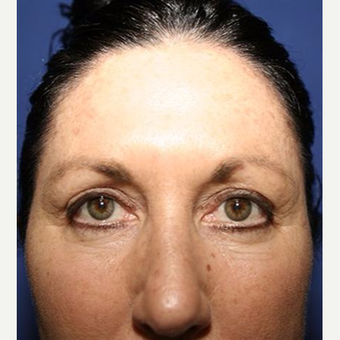 45-54 year old woman treated with Chemical Peel before 3093411