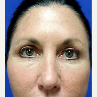 45-54 year old woman treated with Chemical Peel after 3093411