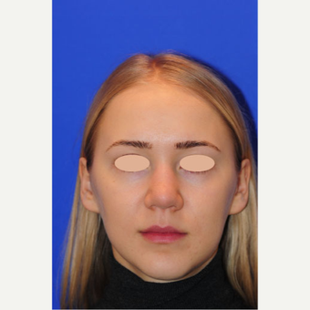 22 year old woman treated with Rhinoplasty before 3163345