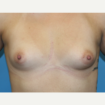 29 year old woman treated with Breast Augmentation before 3486748
