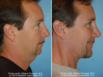 Neck Liposuction before 1389496