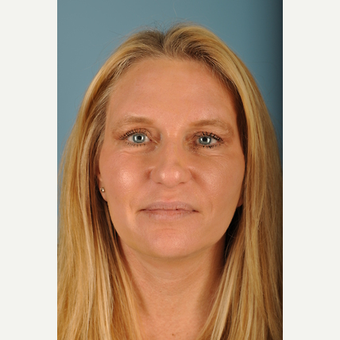 51 year old woman treated with Facelift after 3839592
