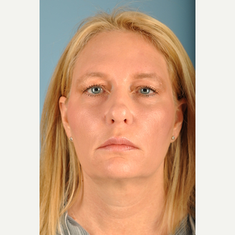 51 year old woman treated with Facelift before 3839592