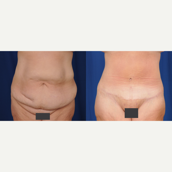 35-44 year old woman treated with Tummy Tuck before 3536499