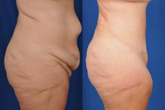 35-44 year old woman treated with Tummy Tuck after 3536499