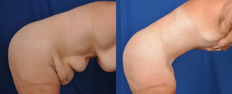 35-44 year old woman treated with Tummy Tuck 3536499