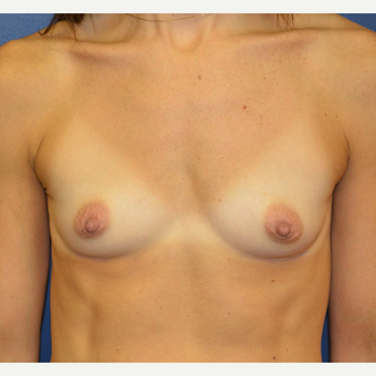 35-44 year old woman treated with Breast Augmentation before 3098875