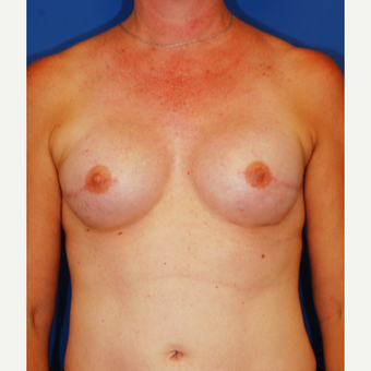 35-44 year old woman treated with Breast Reconstruction after 3619176
