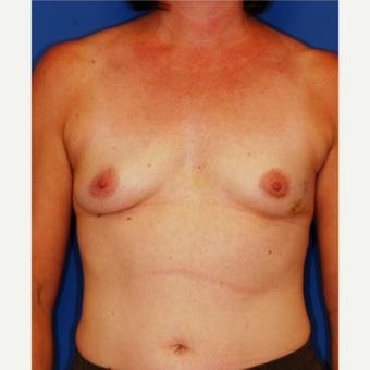 35-44 year old woman treated with Breast Reconstruction before 3619176