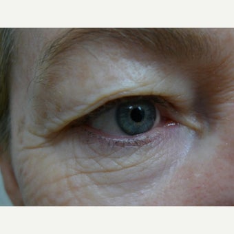 Eyes can also be treated with laser before 1611933