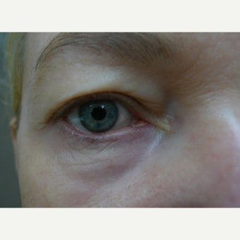 Eyes can also be treated with laser after 1611933