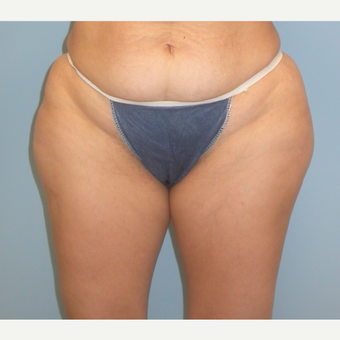 41 year old woman treated with Liposuction before 3142147