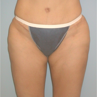 41 year old woman treated with Liposuction after 3142147