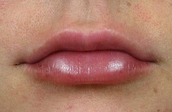 Lip Augmentation with Lip Implants after 1239496